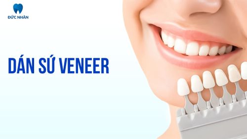Dán Sứ Veneer
